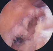 Illustration 40 for Optimizing Single-Bundle Anterior Cruciate Ligament Repair