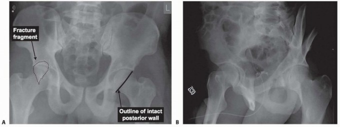 Mastering Posterior Wall Fractures: ORIF Techniques