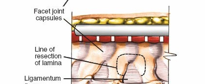 Illustration 183 for Approach to the Lumbar Spine: Mastering Techniques & Anatomy