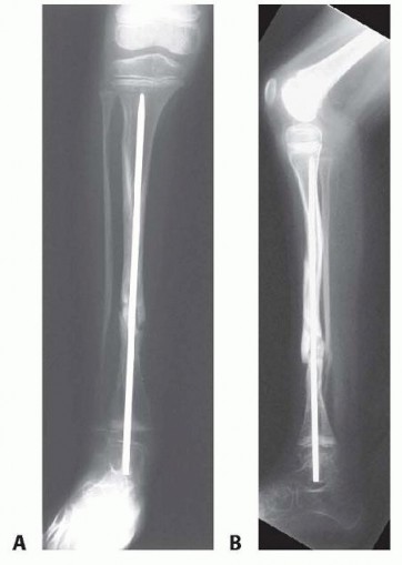 Illustration 10 for Williams Rod: Achieve Stability for Pseudarthrosis within the Tibia