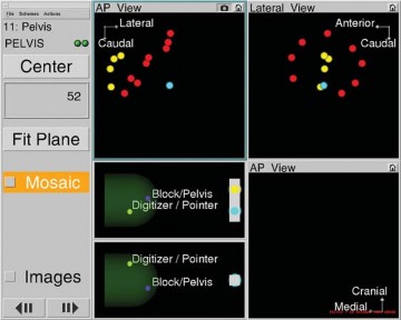 Illustration 17 for Avoiding Errors: Navigation in Total Hip Arthroplasty
