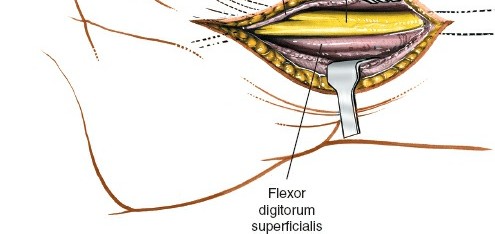 Illustration 71 for Essential Surgical Approaches: Uncover Every Aspect of the Wrist