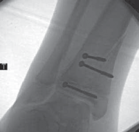 Illustration 44 for Pediatric Ankle Fractures: Management to Prevent Long-Term Issues