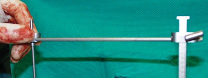 Illustration 18 for Cementless Femoral Stems: Master Indications & Avoid Pitfalls