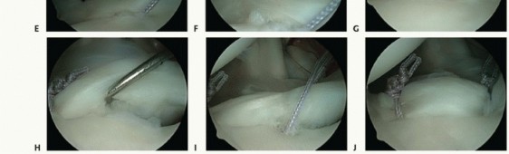 Illustration 6 for Relief for MDI: Expert Treatment of Multidirectional Shoulder Instability