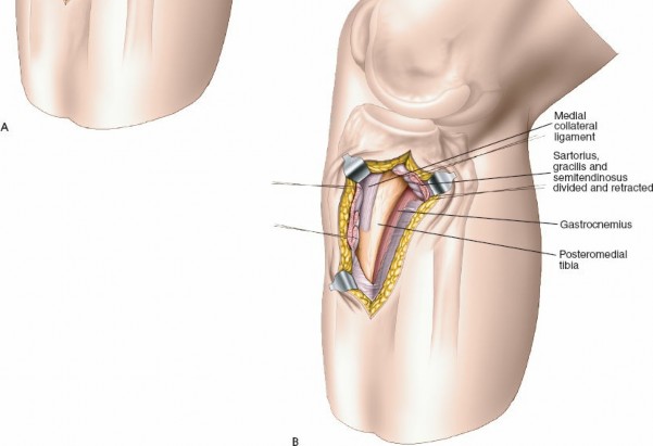 Illustration 20 for Surgical Access: Mastering the Tibia's Surface & Fibula Approaches