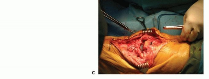 Illustration 7 for Patella Tendon Rupture Reconstruction in Revision TKA