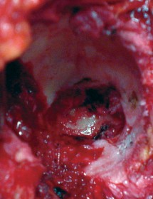 Illustration 24 for Mastering the Cementless Acetabular Cup: Techniques for Optimal Fixation