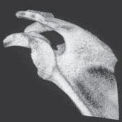 Illustration 4 for Regain Stability: Anterior Shoulder Instability Arthroscopic Fix