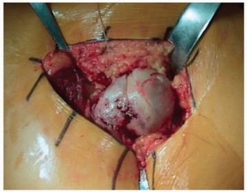 Illustration 6 for Unlock Precision: The Direct Lateral Approach for THA
