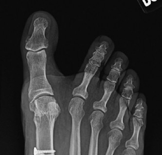 Illustration 2 for Medial Eminence Resection: Avoiding Hallux Varus & Recurrence