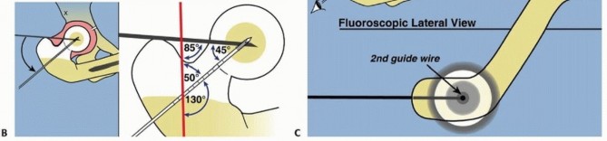 Illustration 22 for Treatment for Congenital Femoral Deficiency: What You Need to Know