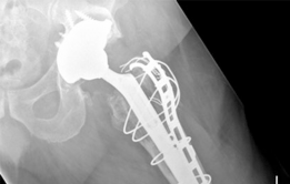 Illustration 9 for Revision THA: Unlocking Stability with Porous Tantalum Cups