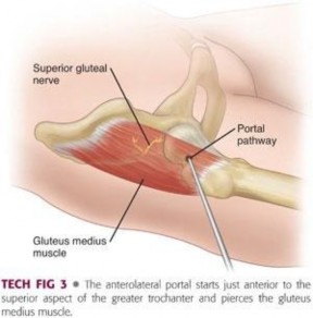 Illustration 192 for Understanding Hip Arthroscopy: The Basics Explained