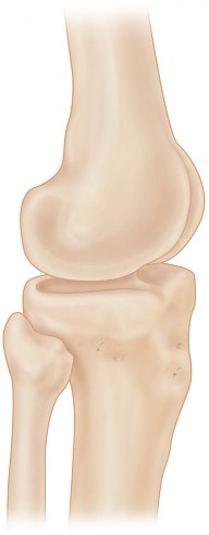 Illustration 6 for Structural Allografting Figure Guide: Solutions for Bone Deficiency