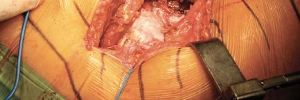 Illustration 18 for Metal on Metal Resurfacing: Enhanced Posterior Soft Tissue Repair