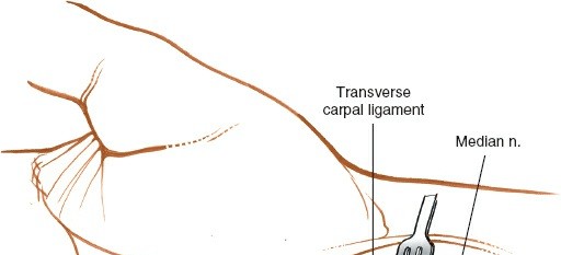 Illustration 19 for Volar Approach: Optimal Exposure for the Volar aspect of the Distal Radius