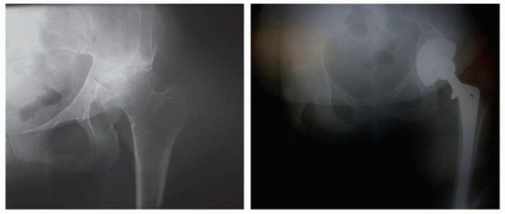 Illustration 3 for Mastering Femoral Head Autograft in DDH Hip Reconstruction