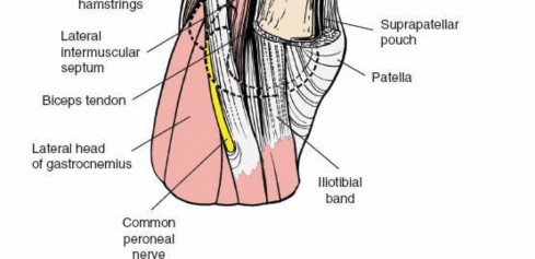 Illustration 96 for Optimal Femoral Approaches: Mastering the Lateral Intermuscular Septum