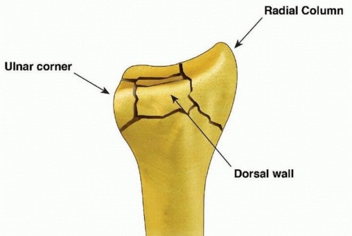 Illustration 4 for Fragment-Specific Fixation: Restore Carpal Facet Horizon