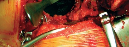 Illustration 34 for Cemented Component Longevity: The Critical Margin of the Acetabulum