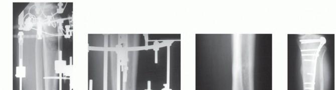 Illustration 25 for Beyond Amputation: Circular Fixation for Infection of the Talus