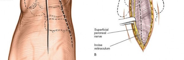 Illustration 5 for Optimized Approaches to the Dorsum of the Foot & Ankle
