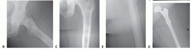 Illustration 12 for Regain Mobility: Total Hip Arthroplasty for Malignant Lesions