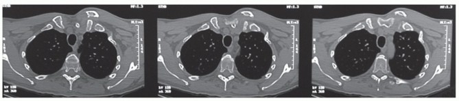 Illustration 15 for Optimizing SC Dislocation Repair After Medial Clavicle Resection
