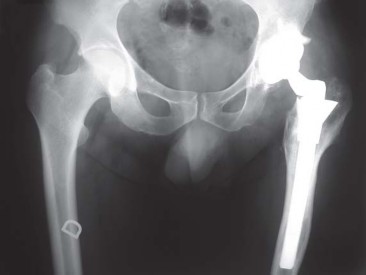 Illustration 40 for S-ROM: Inside the Technique of Modular Implant Design
