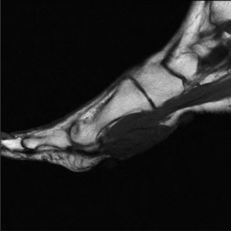 Illustration 4 for Foot Nodule Pain? Solutions for Masses along the Medial Cord