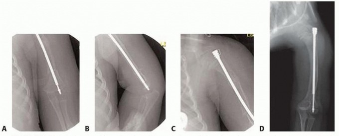 Illustration 32 for Less Pain, More Function: Fassier-Duval Nailing for Osteogenesis Imperfecta