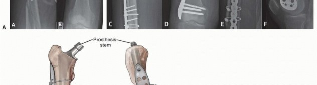 Illustration 16 for Mastering Fixation of Periprosthetic Fractures of the Femur