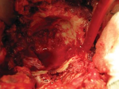 Illustration 23 for Navigating Early THA for Fractures of the Acetabulum