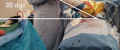 Illustration 51 for Kinectiv® Stem: Modular Necks for Primary THA Success