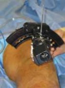 Illustration 7 for Conquering Adolescent Blount's Disease: A Surgical Guide