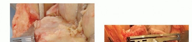 Illustration 11 for Achieve Lasting Pain Relief with Cemented Total Knee Arthroplasty