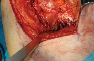 Illustration 7 for Femoral Stem Revision: Posterior Approach for Better Outcomes
