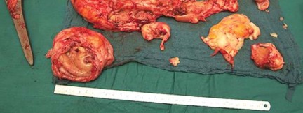 Illustration 43 for Optimizing Infected THA: The One Staged Approach Explained