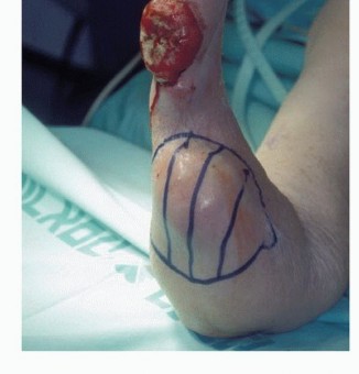 Illustration 9 for Above-Elbow & Below-Elbow Amputations: When & Why They're Needed