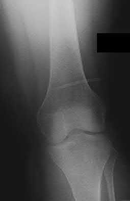 Illustration 164 for OrthoCash: Trauma MCQs & Cases for a yearold woman