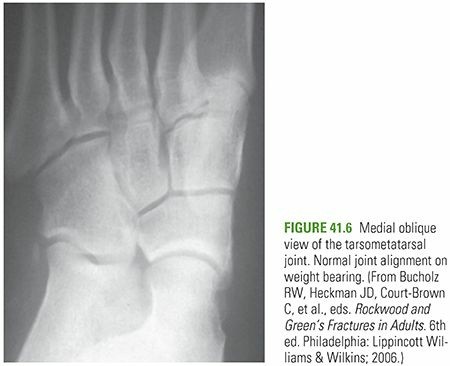 Illustration 19 for Mastering First MTP Joint & Forefoot Fractures: A Comprehensive Guide
