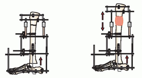 Illustration 19 for Beyond Amputation: Circular Fixation for Infection of the Talus