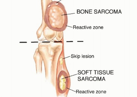 Illustration 5 for Precision Biopsy of Musculoskeletal Tumors for Accurate Diagnosis