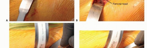 Illustration 28 for Anterior FAI Relief: Mini-Open Anterior Approach Explained