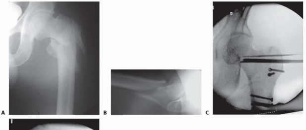 Illustration 17 for ORIF for Peritrochanteric Hip Fractures: Achieve Stable Mobility