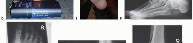 Illustration 50 for How Achilles Tendon Lengthening Fixes Equinocavovarus Foot