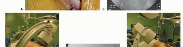 Illustration 23 for Emergency Fixation of the Pelvis: Control Bleeding & Restore Stability