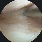 Illustration 19 for Guide Pin Assembly: Key to Flawless Upper Tibial Osteotomy