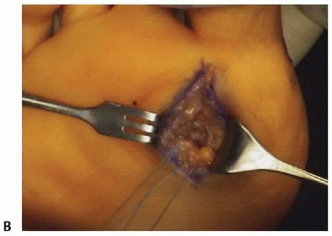 Illustration 17 for Restore Your Foot: Surgical Treatment for Hallux MP Joint Turf Toe